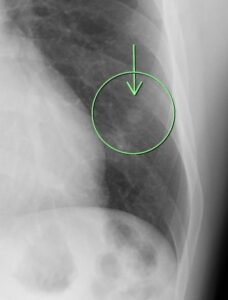 検診で見つかった肺の異常影 ｜ よくあるご質問｜ましもと内科呼吸器科
